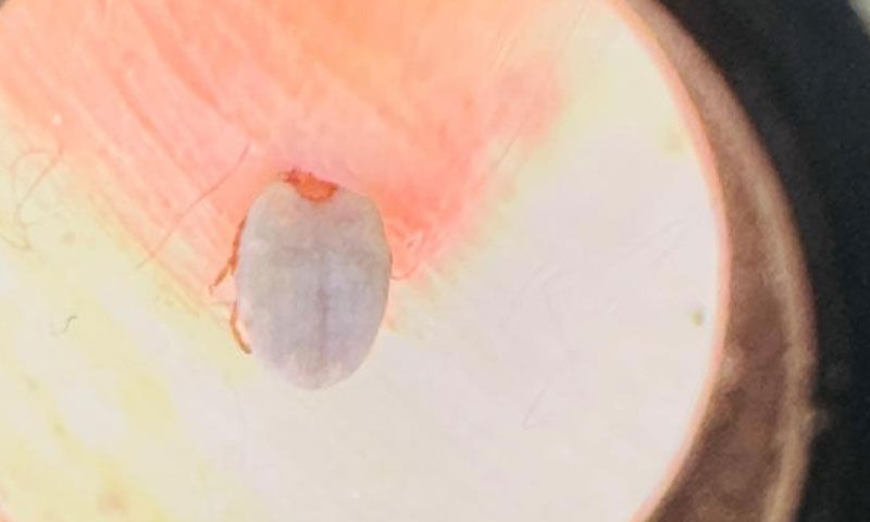 Yorgunluk şikayetiyle gitti, göbekten kene çıktı