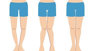 Çocuklarda bacak eğriliği dikkat istiyor!