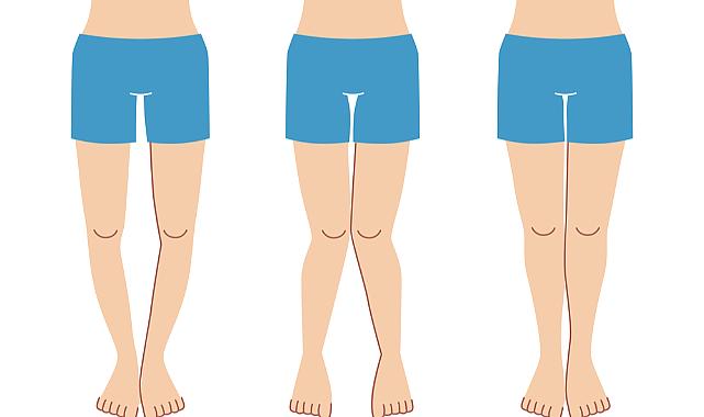 Çocuklarda bacak eğriliği dikkat istiyor!