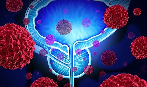 Prostat kanserinde hayat kurtaran 4 öneri