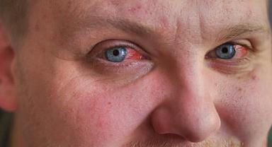 Gözleri kanatan virüs tespit edildi: Salgın korkusu başladı