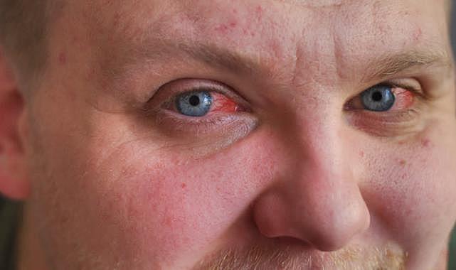 Gözleri kanatan virüs tespit edildi: Salgın korkusu başladı