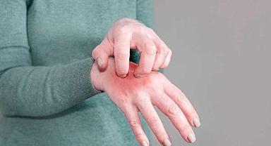 Uyuz kabusu büyüyor: Bu uyarılara dikkat!