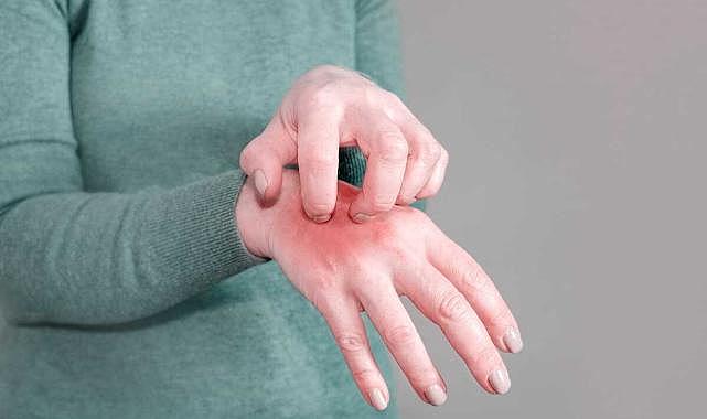 Uyuz kabusu büyüyor: Bu uyarılara dikkat!