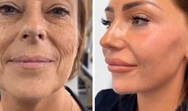 Yüz Gerdirme Ameliyatı ile Gençleşen Kadın Sosyal Medyayı Salladı
