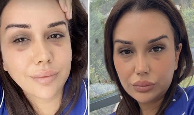 &quot;Geçim sıkıntısı çekiyorum&quot; diyen Dilan Polat&#039;tan yüz gerdirme ameliyatı