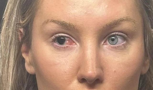 Çanta kayışı yüzünden kör oldu!