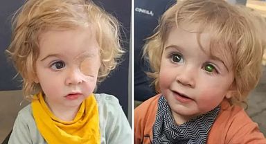 2 yaşındaki çocuk bir öpücük yüzünden gözünü kaybetti