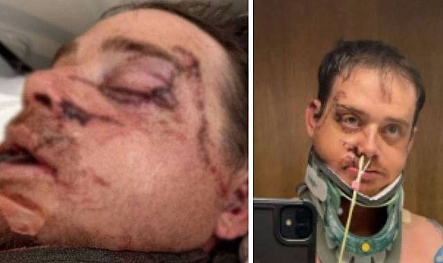 Kullandığı dozerin altında kalınca kabusu yaşadı! &#039;&#039;Yüzümün yarısı artık yok&#039;&#039;