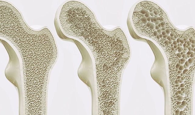 D vitamini eksikliği kemik erimesine yol açıyor