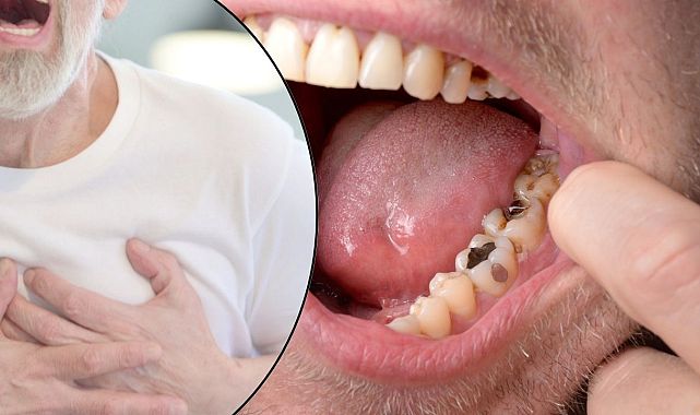 Diş Çürüğü Ölümle Sonuçlanabilir! Uzman Kardiyologdan Hayati Uyarı