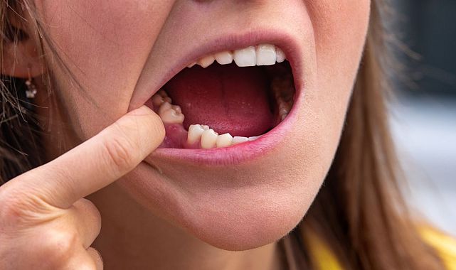 Diş eksikliği sadece estetik değil, sağlık riski
