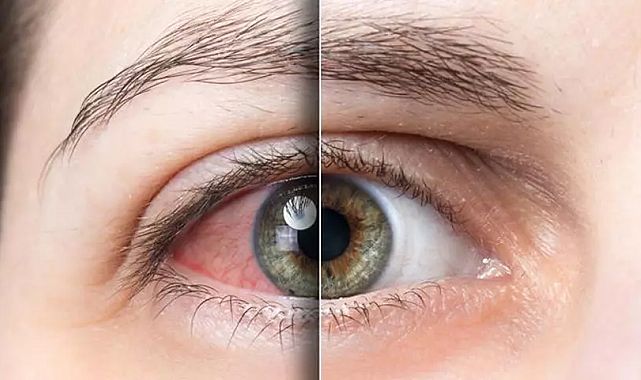 Gözde yanma ve batmaya dikkat: Nedeni kuru göz