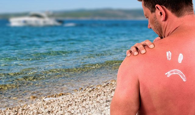 Güneş yanığında ilk yardım: Buz uygulaması tehlikeli