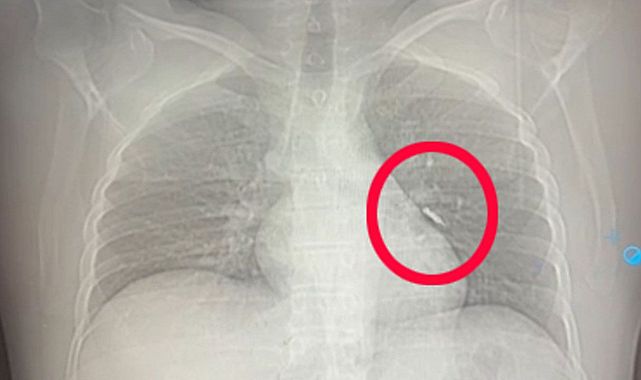 İmplant vidası soluk borusuna kaçtı, hasta kurtuldu