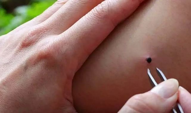 İstanbul ve İzmir&#039;de kene vakaları iklimle birlikte arttı