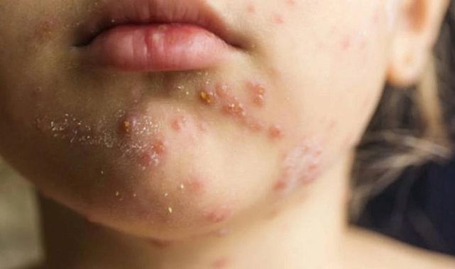 Kızamık salgını ABD’de 33 yılın en yüksek seviyesinde