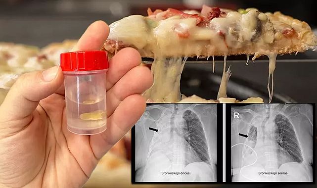 Mısır tanesi akciğerine kaçtı, 5 ay sonra fark edildi