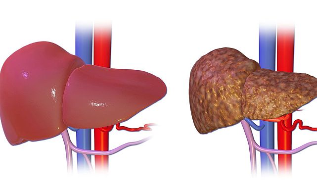Uzman uyardı: Karaciğer yağlanmasında erken belirti yok