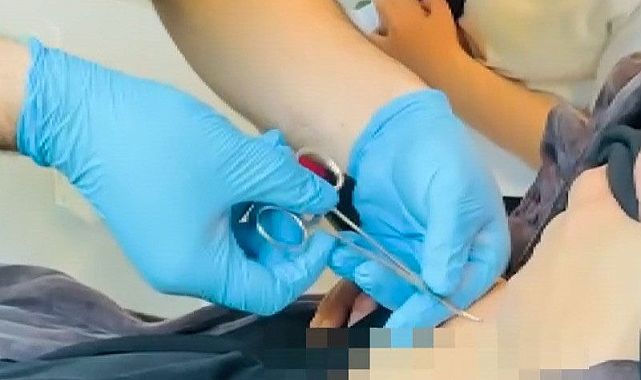 Yorgunluk şikayetiyle gitti, göbekten kene çıktı