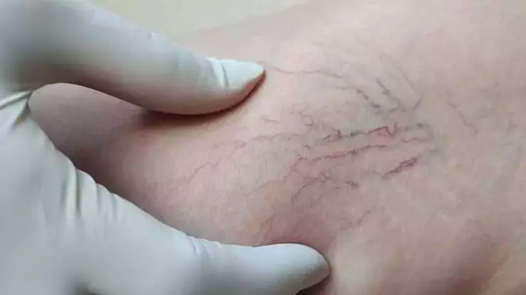 Sıcak Havalarda Varis Riski Artıyor