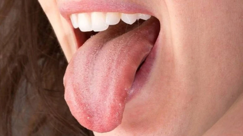 Uzmanlar uyardı: Dildeki bu belirtiyi ciddiye alın