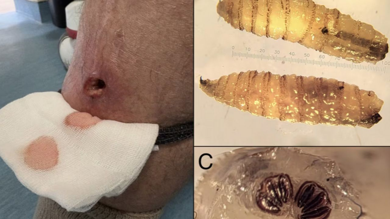 Ölümcül parazit ABD’de insanda görüldü