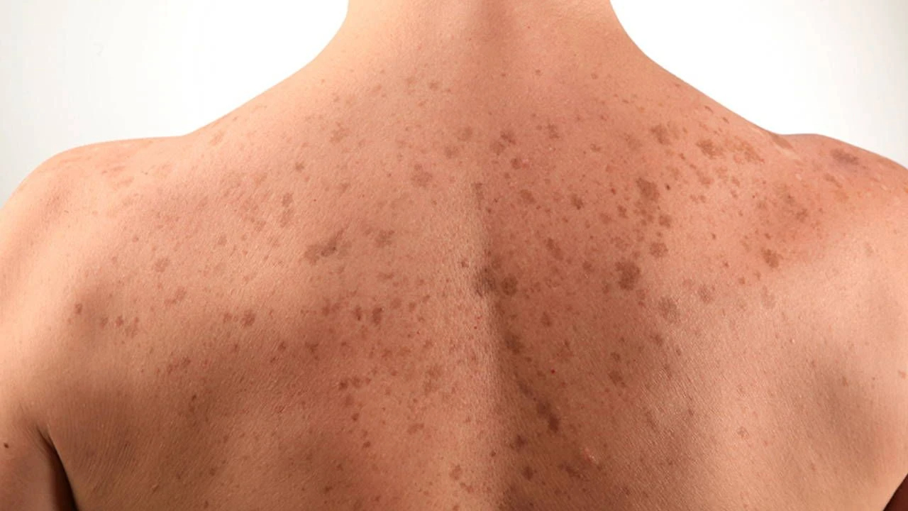 Yazın oluşan cilt lekelerine dikkat!