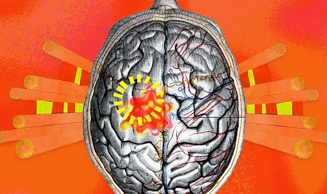 Sıcak hava nörolojik hastalıkları tetikliyor