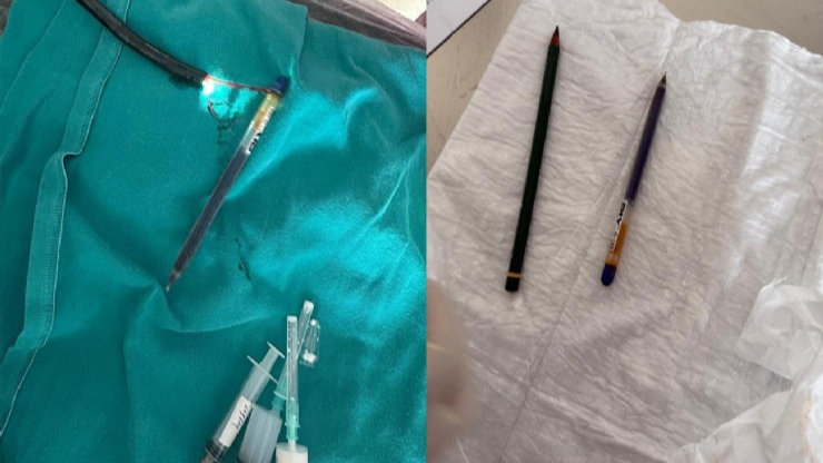 Ağrı’da genç kadının midesinden iki kalem çıkarıldı