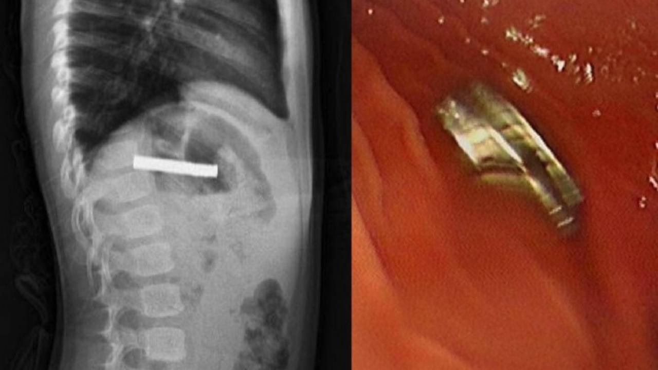 Çocuğun boğazından 19 adet mıknatıs çıkartıldı
